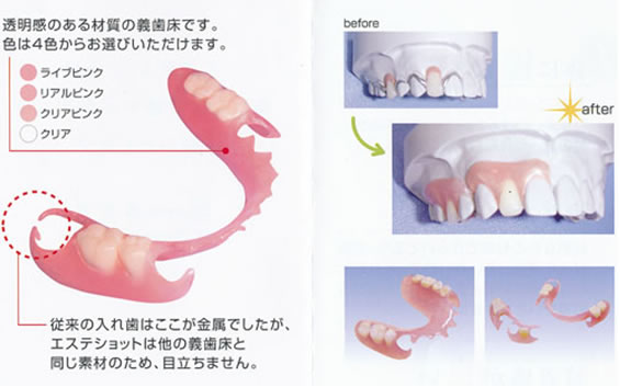 エステショット（ノンクラスプデンチャー）