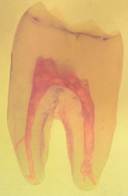 歯髄の複雑性