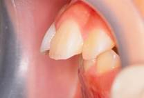 治療前：前歯を横から見たところ