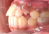 第1期治療後：前歯横面