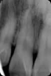 X-線像にてむし歯はありませんが、根管治療が必要です